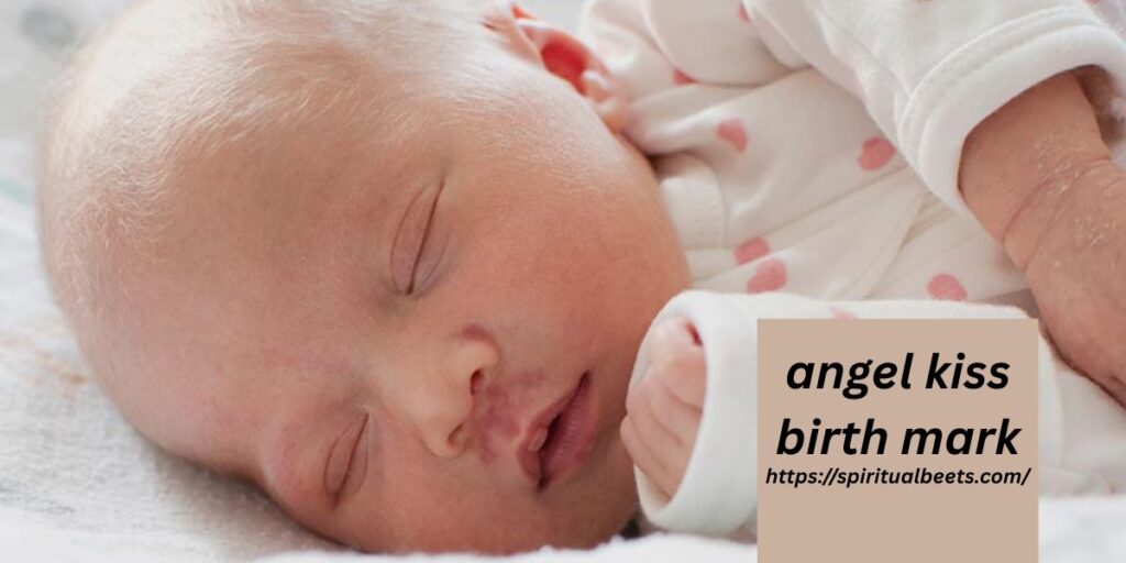 angel kiss birth mark