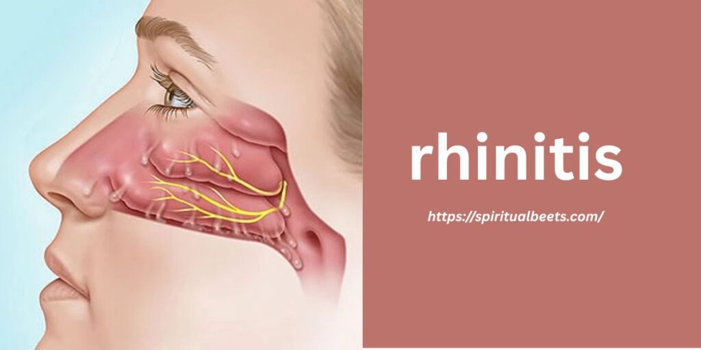 rhinitis